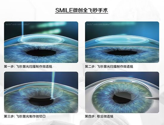 蔡司全飛秒、蔡司半飛秒近視手術與蔡司全飛秒flex手術