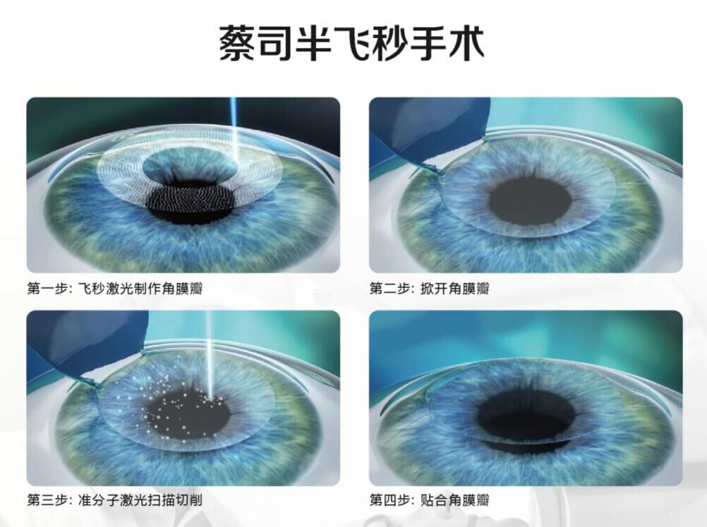 蔡司全飛秒、蔡司半飛秒近視手術與蔡司全飛秒flex手術