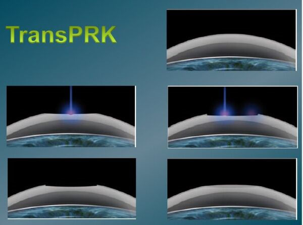 TransPRK手術與蔡司全飛秒手術、半飛秒手術有什么區別?