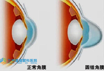 圓錐角膜怎樣？